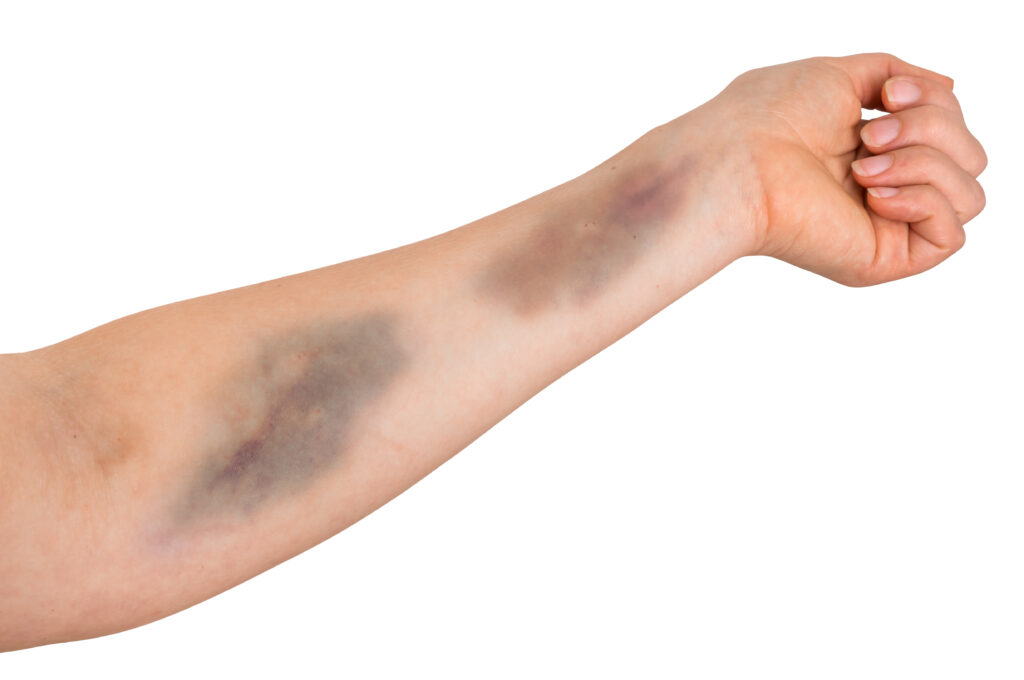瘀青-減重大視界-pic-Large bruise on human arm